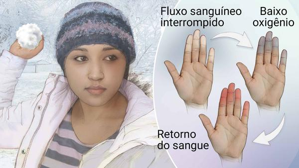 Fenómeno de Raynaud, Síndrome ou Doença de Raynaud