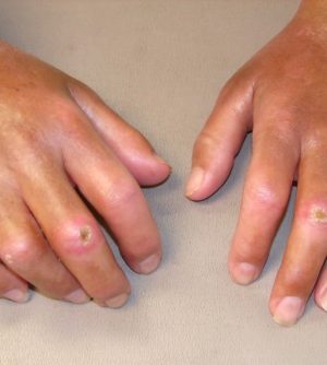 esclerose-sistemica-es