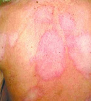 hanseniase-no-seculo-xxi-onde-estamos