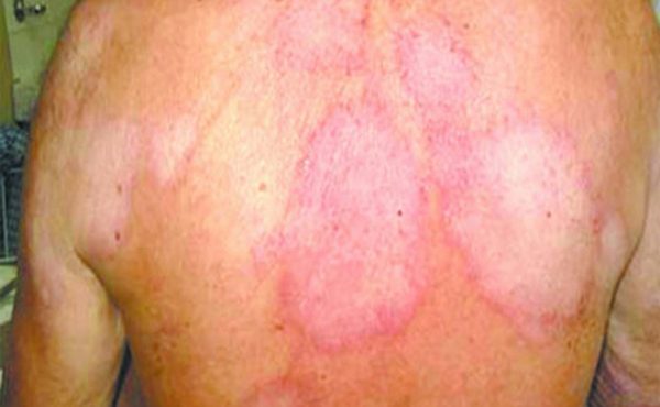 hanseniase-no-seculo-xxi-onde-estamos