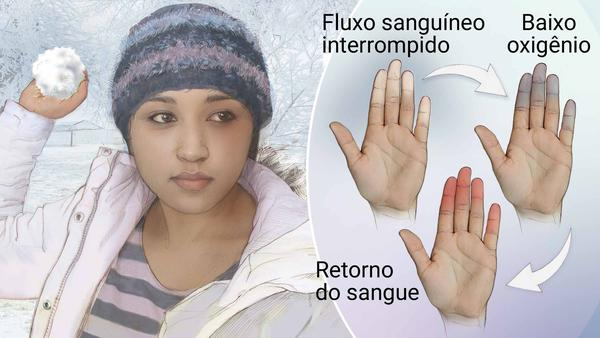 voce-sabe-o-que-e-fenomeno-de-raynaud