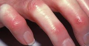 esclerose-sistemica-esclerodermia