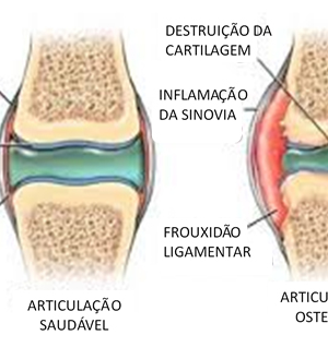 voce-ja-ouviu-falar-em-osteoartrite-nao-mas-em-artrose-ja
