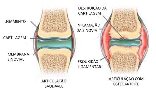 voce-ja-ouviu-falar-em-osteoartrite-nao-mas-em-artrose-ja