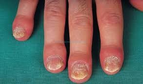 qual-a-relacao-entre-psoriase-e-reumatismo