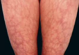 voce-ja-ouviu-falar-em-saaf-que-sindrome-e-esta